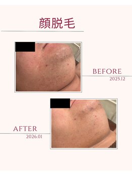 シール(Syl)/メンズ顔脱毛