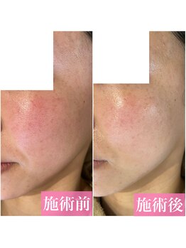 ルアナ(Luana)/【光フォト】1回の変化