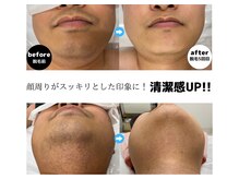 チロル(CHIROL)/メンズ☆髭脱毛