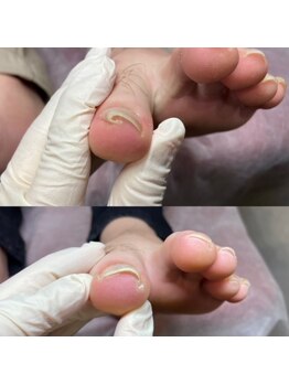 白岡総合整骨院 整体院/巻き爪