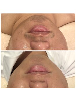 サロンドプレマージュ(Salon de Premage)/メンズ髭脱毛