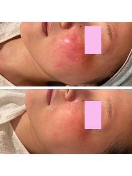 サロン ラズリ 久留米店(SALON Lazuli)/【イオン導入】赤ら顔