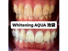 アクア 池袋店(AQUA)/ホワイトニング/池袋/東京/美白