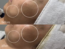 アメリラボ(Ameli Lab)の雰囲気（一度の効果も重視・口元のもたつき/たるみ毛穴/フェイスライン）