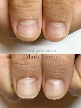 マリーロール 梅田店(Marie Laure)/自爪育成/深爪矯正/ネイルケア