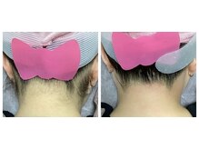 ルル(RuRu)/ Wax脱毛