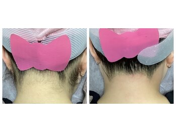 ルル(RuRu)/ Wax脱毛