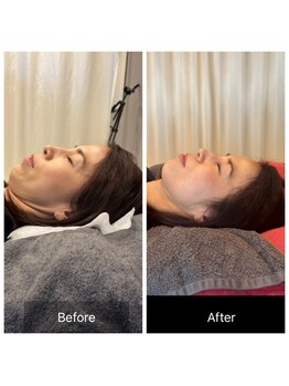 プライミー(PRIMY)/ほうれい線、マリオネット撃退2