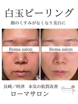 ローマサロン/白玉スノーピールでくすみ飛び♪