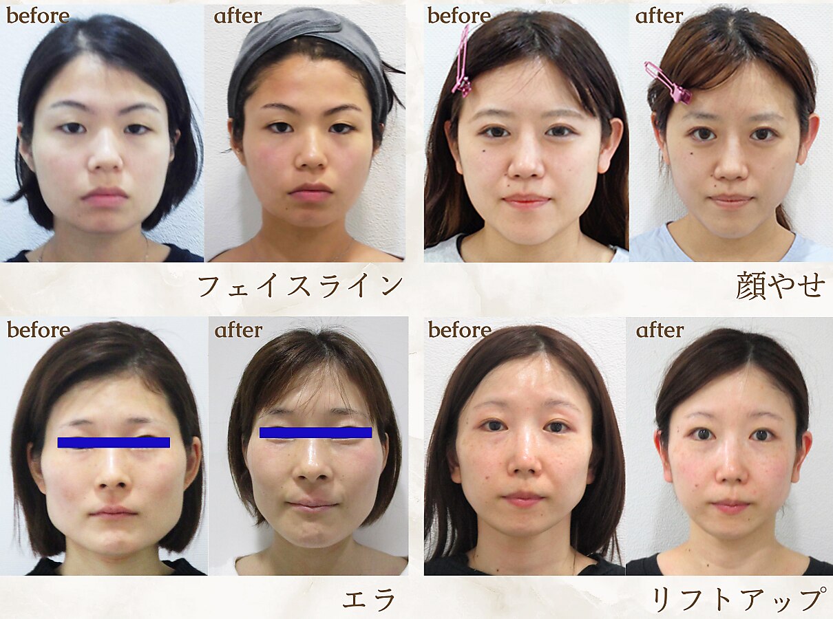 エラ 左右非対称 矯正に関するサロン 骨美整 salon 【コルミチョン