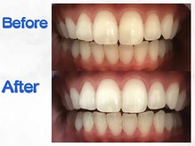 LBSホワイトニング 梅田店/ホワイトニングビフォーアフター
