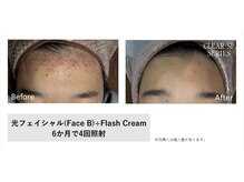 マイプラ(mypla)/光フェイシャル「ニキビ」