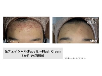 マイプラ(mypla)/光フェイシャル「ニキビ」