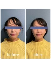 フィジオリハ 久屋大通店/美容筋膜リリース～フェイス～