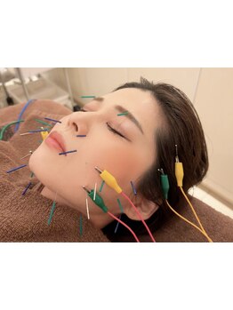 鍼灸施術を受けたい