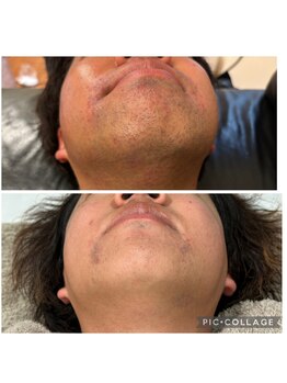 ルナ(Runa)/美肌ヒゲ脱毛◆7回の変化