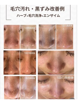 雅菜(miyabina)/毛穴・黒ずみ改善例