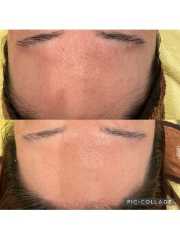 ルナート(Lunart)/毛穴洗浄/毛穴ケア