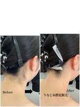 メディカルサロンドオフ 堺東店(medical salon de off)/うなじ襟足脱毛♪