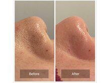 リジュベ(Rejuve)/毛穴エクストラクション[本八幡]