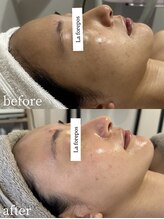 ラ フォルポ 恵比寿(La forepos)/veruna無農薬ハーブピーリング