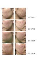 グラン治療院 東京/美容鍼でのニキビの経過 4