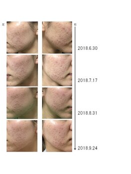 グラン治療院 東京/美容鍼でのニキビの経過 4