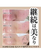 ニュートラル(neutral)/毛穴エクストラクションプロ大分