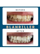 ブランリエ 天王寺阿倍野店(BLANRILLER)/セルフホワイトニング