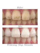 ホワイトニングショップ 静岡店/ホワイトニングBefore→After