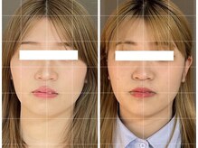 ソルビーフェイス(SOL*BeFace)/お顔の幅が縮小☆3回目