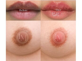 マリナビューティーサロン(Malina BEAUTY SALON)の写真/【★韓国ルメラ×唇・乳輪】予約人気No.1。色素沈着した黒ずみを除去し、血色感のある愛されピンク肌へ