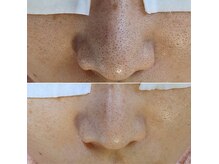 毛穴のことならお任せください！