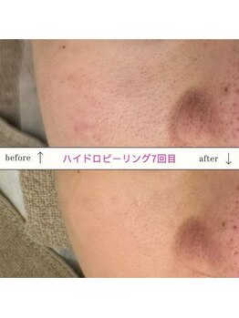 キュオバイアンドリープ(Qo by &LEAP)/ハイドロピーリング