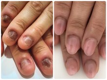 ネイルズシアム/【深爪矯正】即日見た目改善