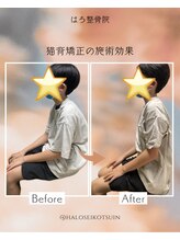 はろ整骨院/猫背・反り腰/巻き肩矯正