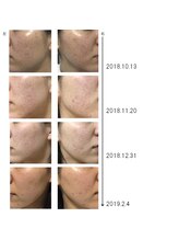 グラン治療院 東京/美容鍼でのニキビの経過 5