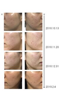 グラン治療院 東京/美容鍼でのニキビの経過 5