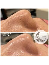 ルーナ(LUNA)/☆ハイドロスキン1回施術結果☆
