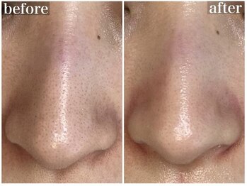 ホワイトアクア 姫路店(WHITE AQUA)/ララピール/姫路/毛穴ケア