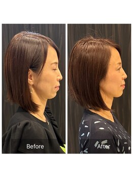 プライミー(PRIMY)/ほうれい線、マリオネット撃退3