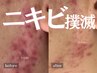 【ニキビ】本格ニキビケアハーブピーリング+IPSP幹細胞導入 ¥16,500