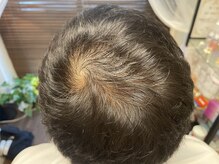 ココ 2号店(CoCo)/5/11ハーブ棘ケア/頭皮環境改善