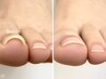 【フット】親指のみ/巻き爪1本ケア＋クリア仕上げ
