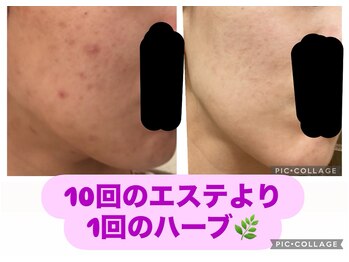 ジェミー(Gemmy)/肌質改善