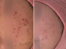 ケイ(K)/おでこニキビ｜赤み肌を改善