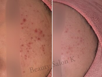 ケイ(K)/おでこニキビ|赤み肌を改善