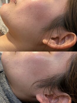 スムー 金沢小橋町店(Smoo)/ハーブピーリング