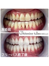 ホワイトニングサロン 京都烏丸店/ホワイトニング施術例