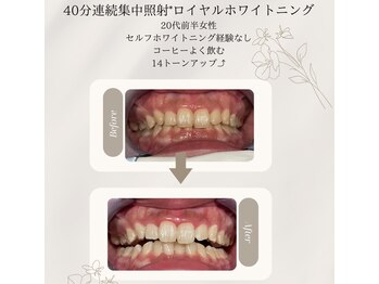 プラスビーセルフ(+b self)/ホワイトニングビフォーアフター